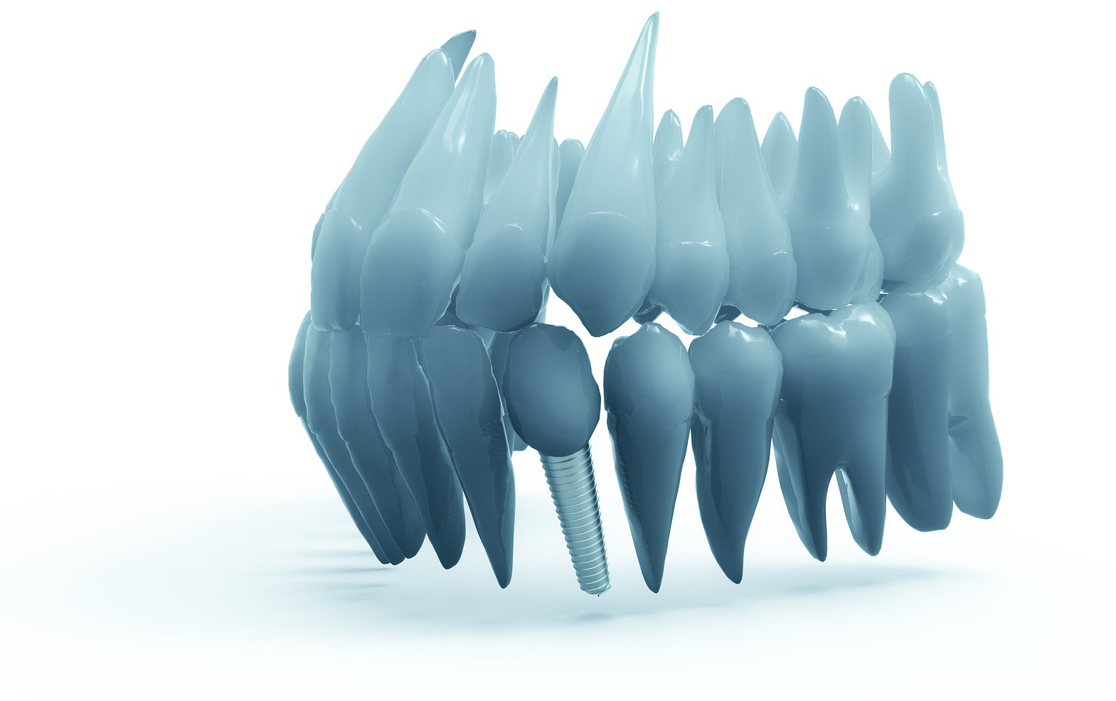 Implantate Implantate