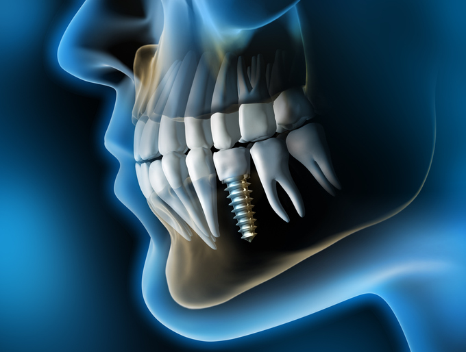 MeinZahnarzt Innsbruck - Nahaufnahme eines Zahnimplantats mit Krone im Unterkiefer vor dunklem Hintergrund - 3D Illustration