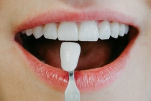 MeinZahnarzt - Bleaching Zähne aufhellen in Innsbruck Weiße Zähne